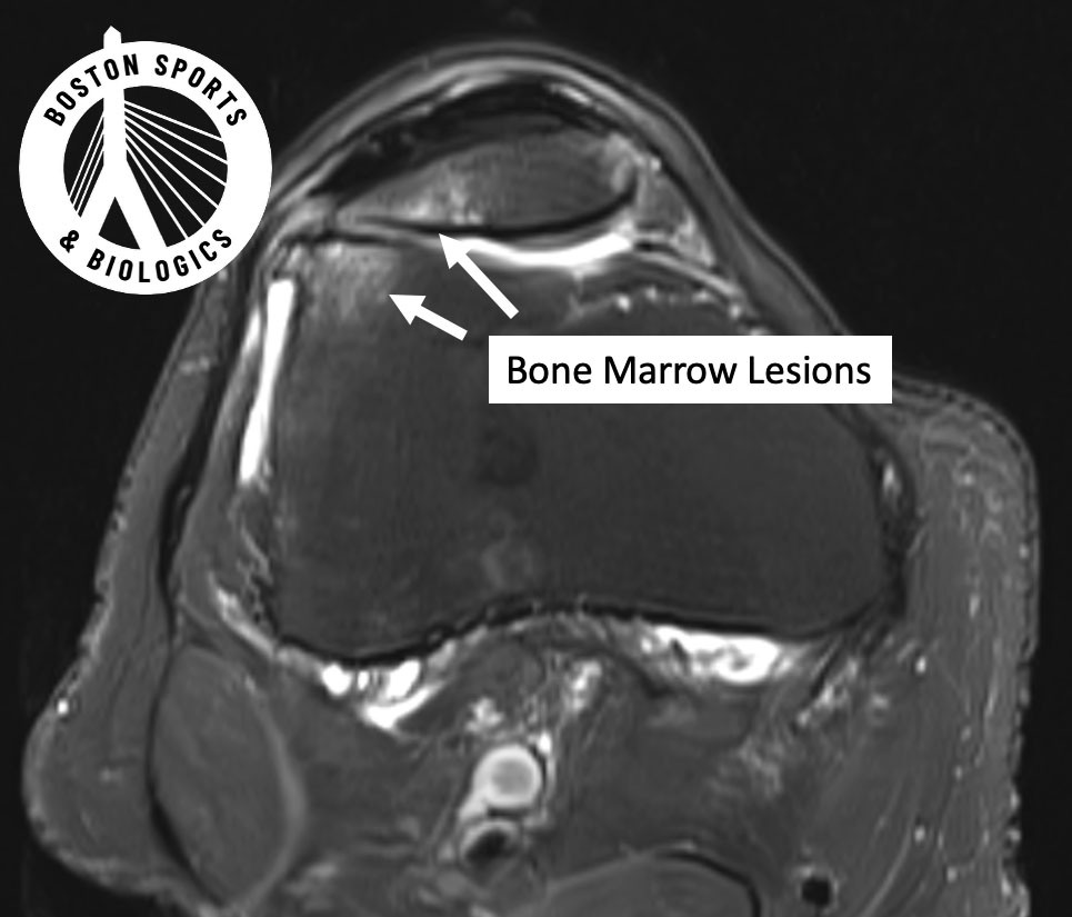 Bone marrow lesion PRP bone marrow stem cell injection