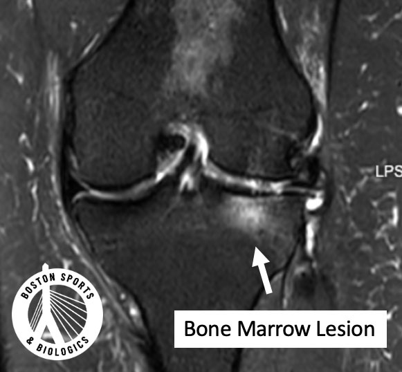 Bone marrow edema on MRI significance.