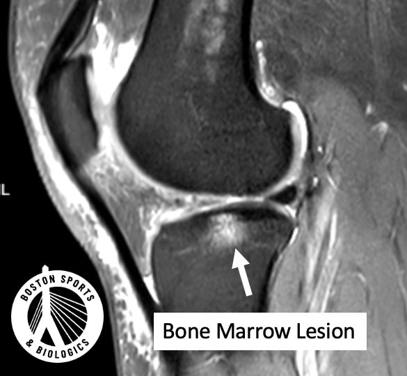 Significance of bone marrow edema on MRI.