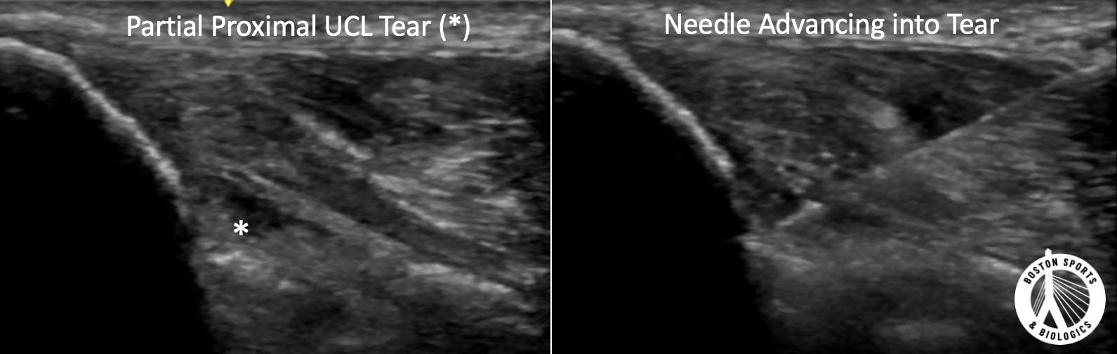 PRP injection for partial UCL (ulnar collateral ligament) tear