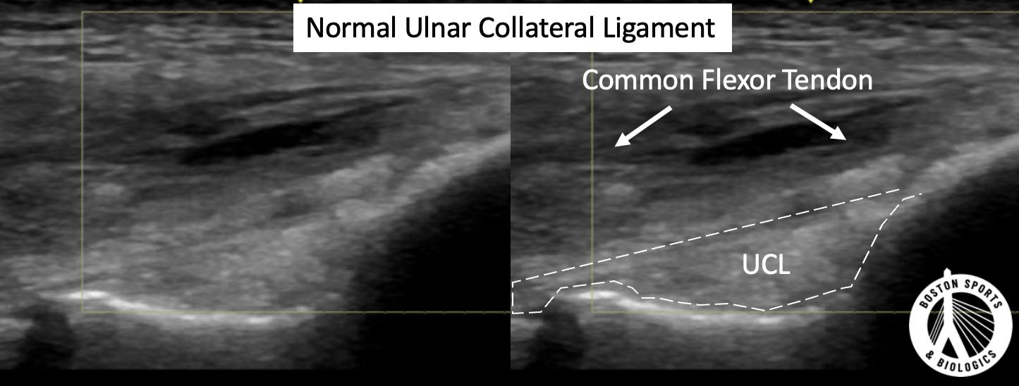 Ultrasound of normal UCL (ulnar collateral ligament) of the elbow.