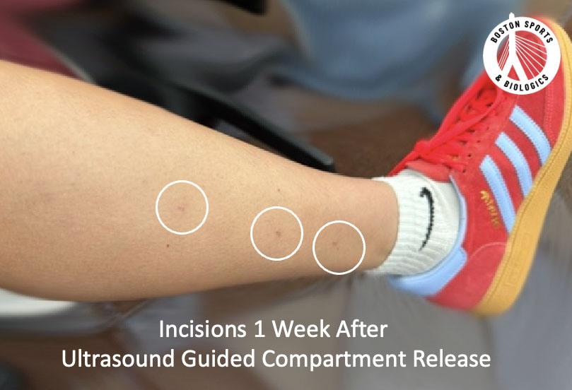Ultrasound-guided fasciotomy/compartment release for chronic exertional compartment syndrome.