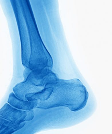 Boston Sports Tenex Bone Haglund Deformity Bone Spur Heel Spur