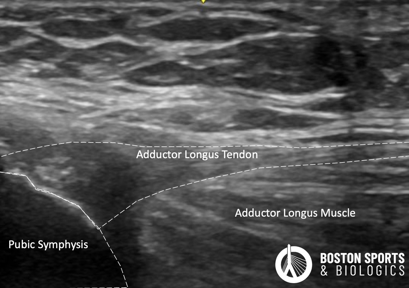 Ultrasound image of the adductor longus tendon. The tendon is selectively cut in a limited tenotomy.