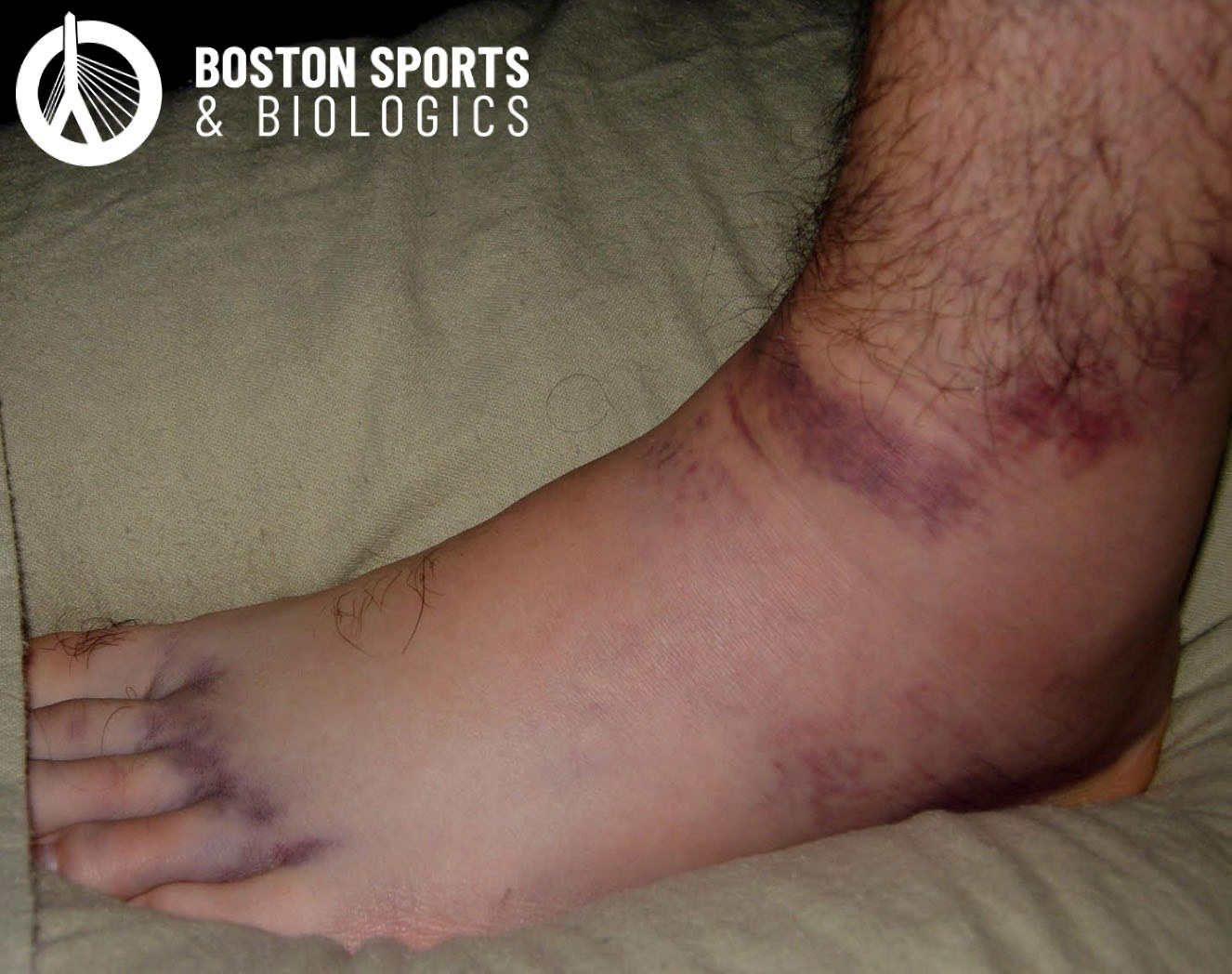 Ankle Sprain: Elite Sports Medicine + Orthopedics: Orthopedics