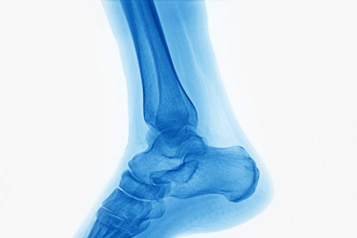 Haglund's Deformity - All You Need To Know - Feet First Clinic