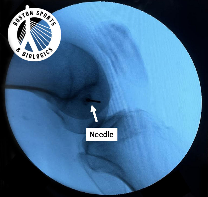Intra-osseous bone marrow lesions PRP or stem cell injection