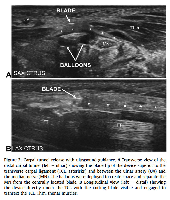 Ultrasound images showing the Sonex device in place.