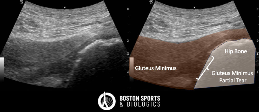 Ultrasound of Gluteus Minimus Tear