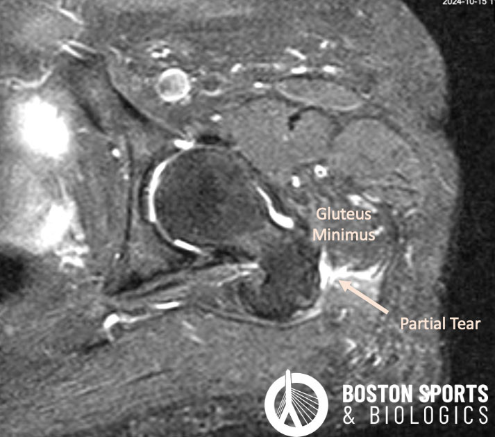 MRI of Gluteus Minimus Partial Tear