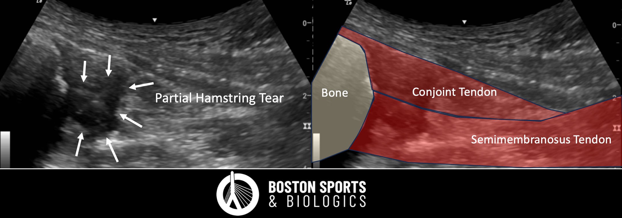 Ultrasound of a Hamstring Partial Tear