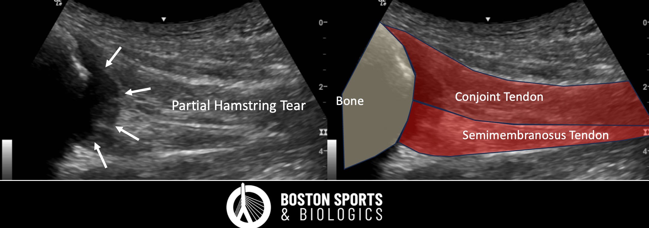 Ultrasound of a Hamstring Partial Tear