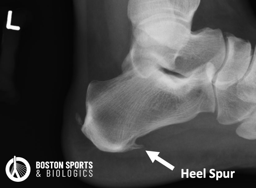 X-ray of a heel spur associated with plantar fasciiitis.