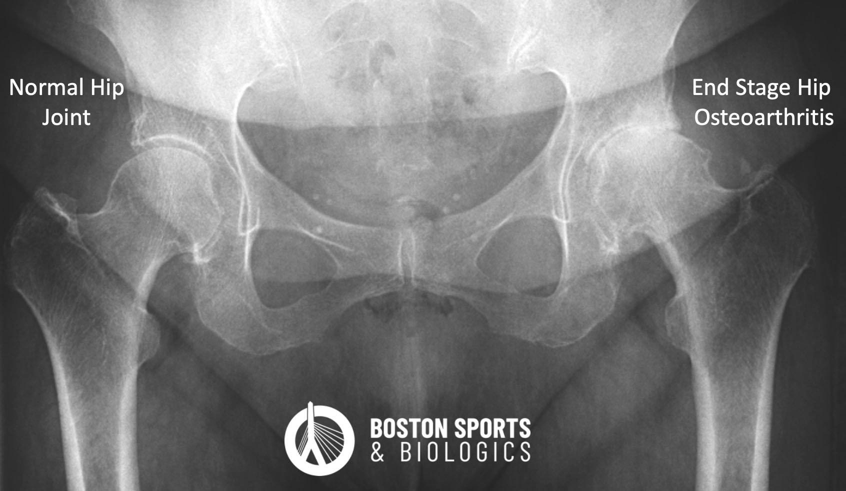 Radiograph of Hip Osteoarthritis