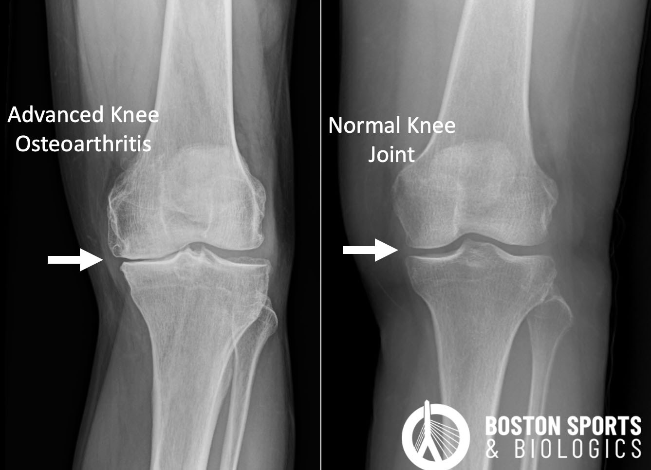 Radiograph of knee with osteoarthritis