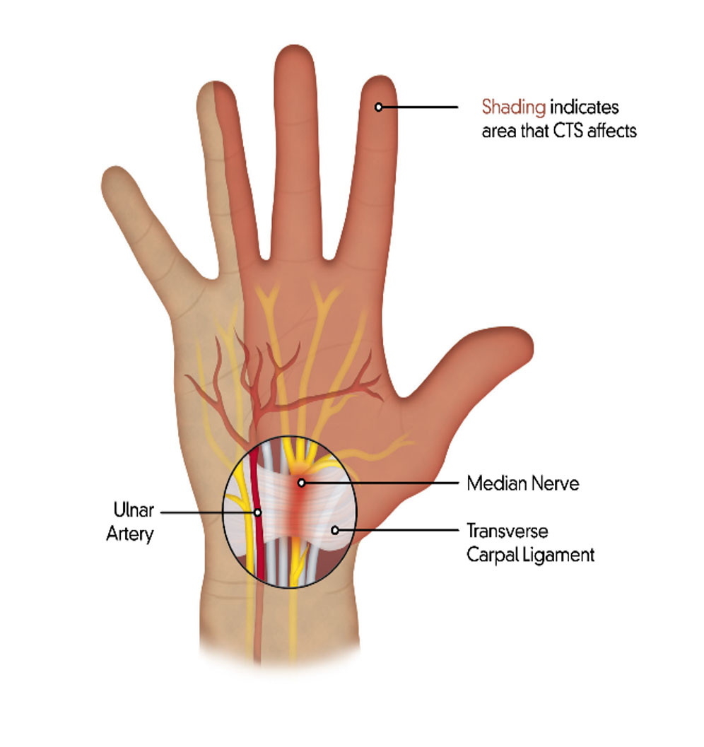 Predisposing factors that might be implicated in carpal tunnel syndrome