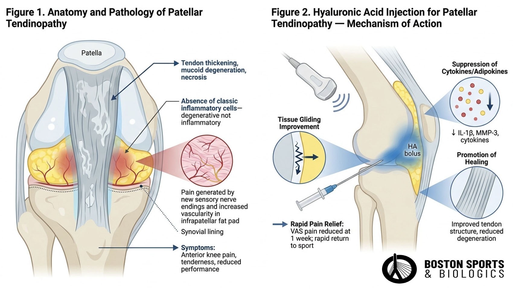 Chronic patellar tendinopathy and hyaluronic acid injections/viscosupplementation inections