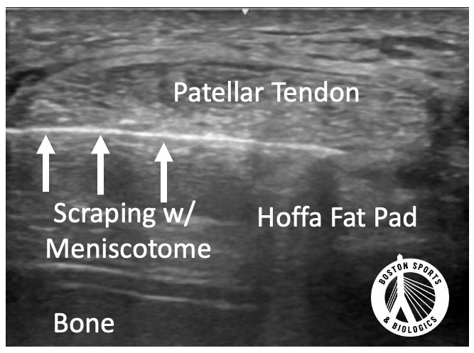 Patellar tendon scraping, long-axis ultrasound.