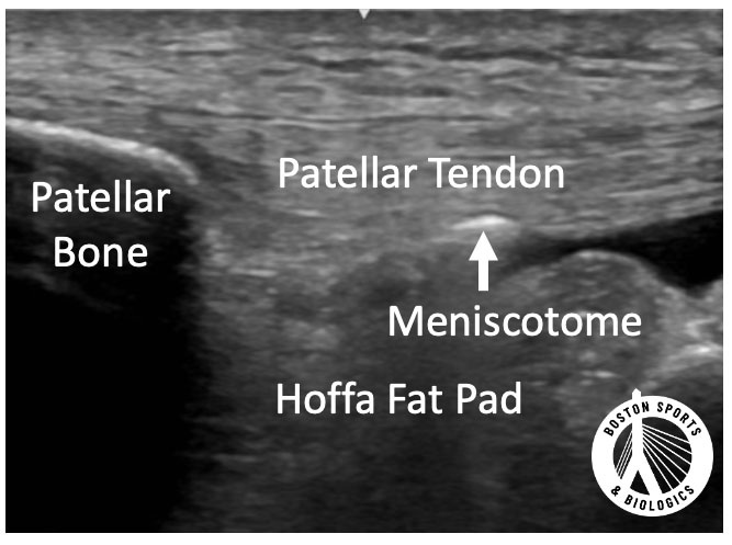 Patellar tendon scraping, short-axis ultrasound.