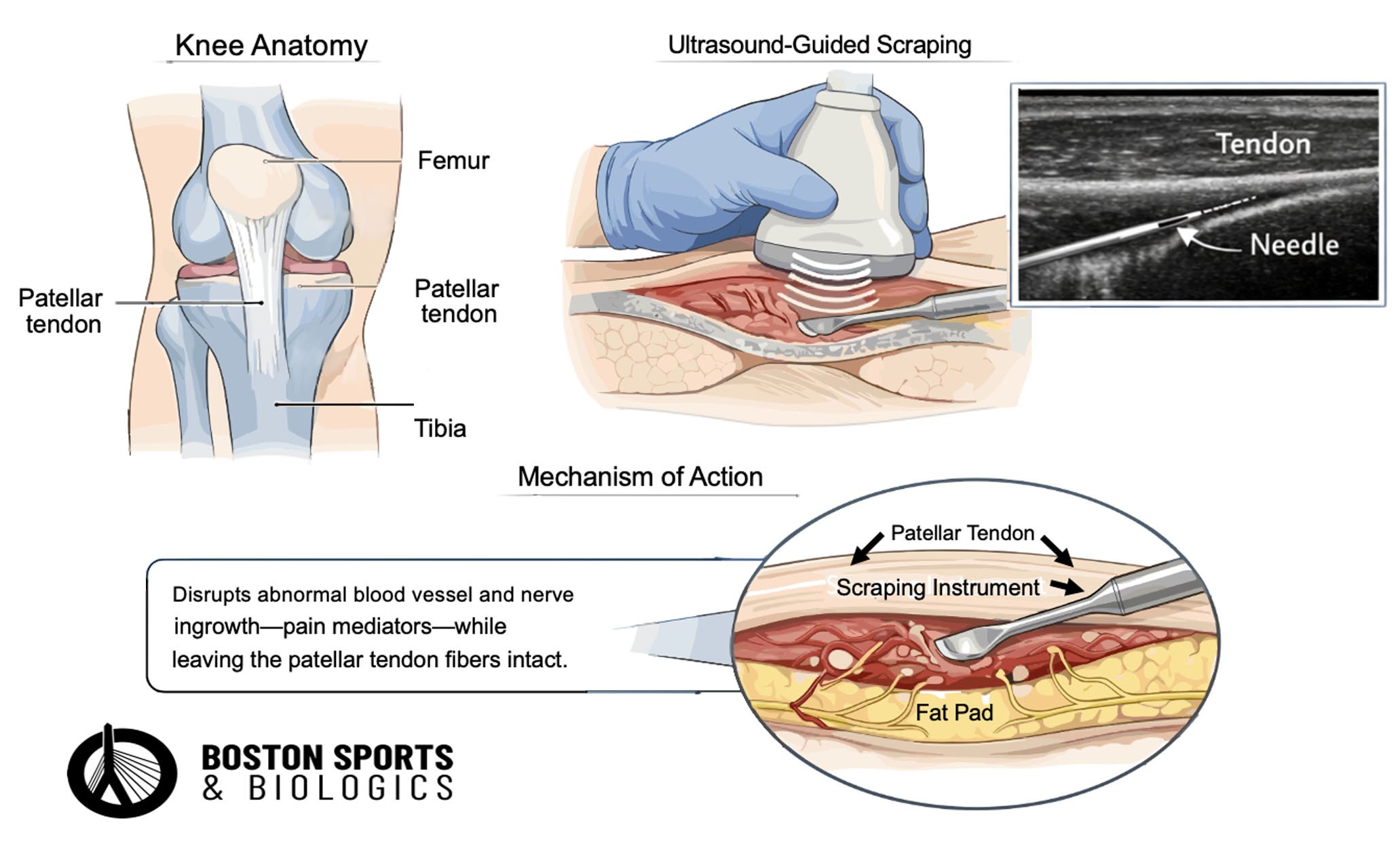 Patelar tendon scraping.