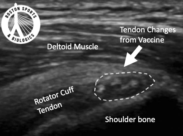 Diagnosing Shoulder Injury Related to Vaccine Administration (SIRVA) with ultrasound.