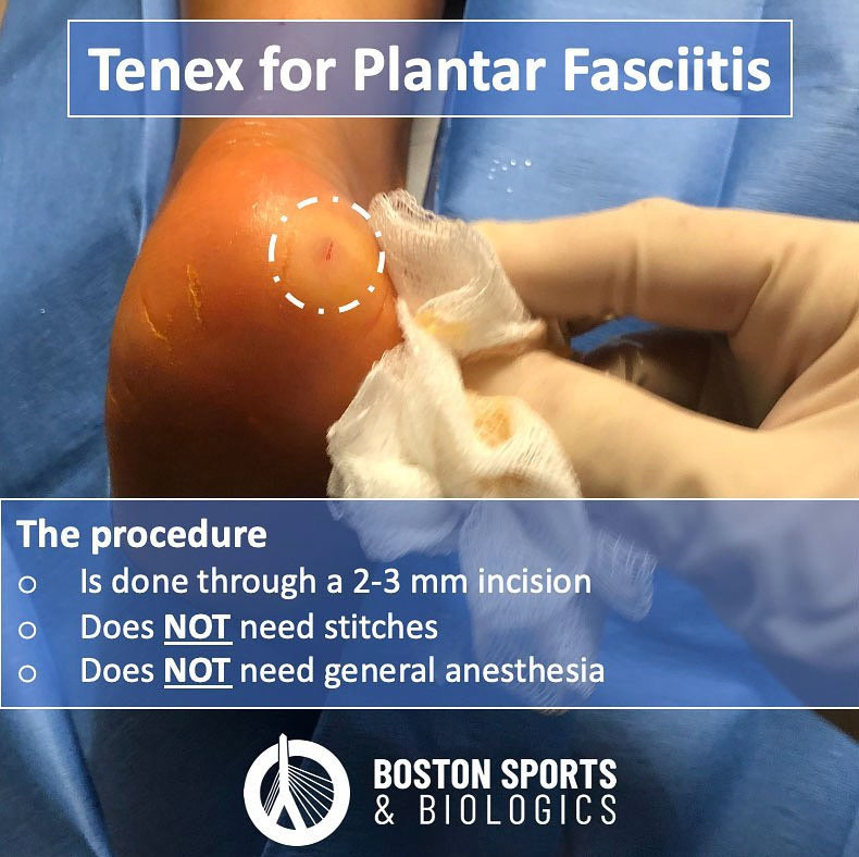 Tenex Plantar Fasciotomy for Chronic Plantar Fasciitis