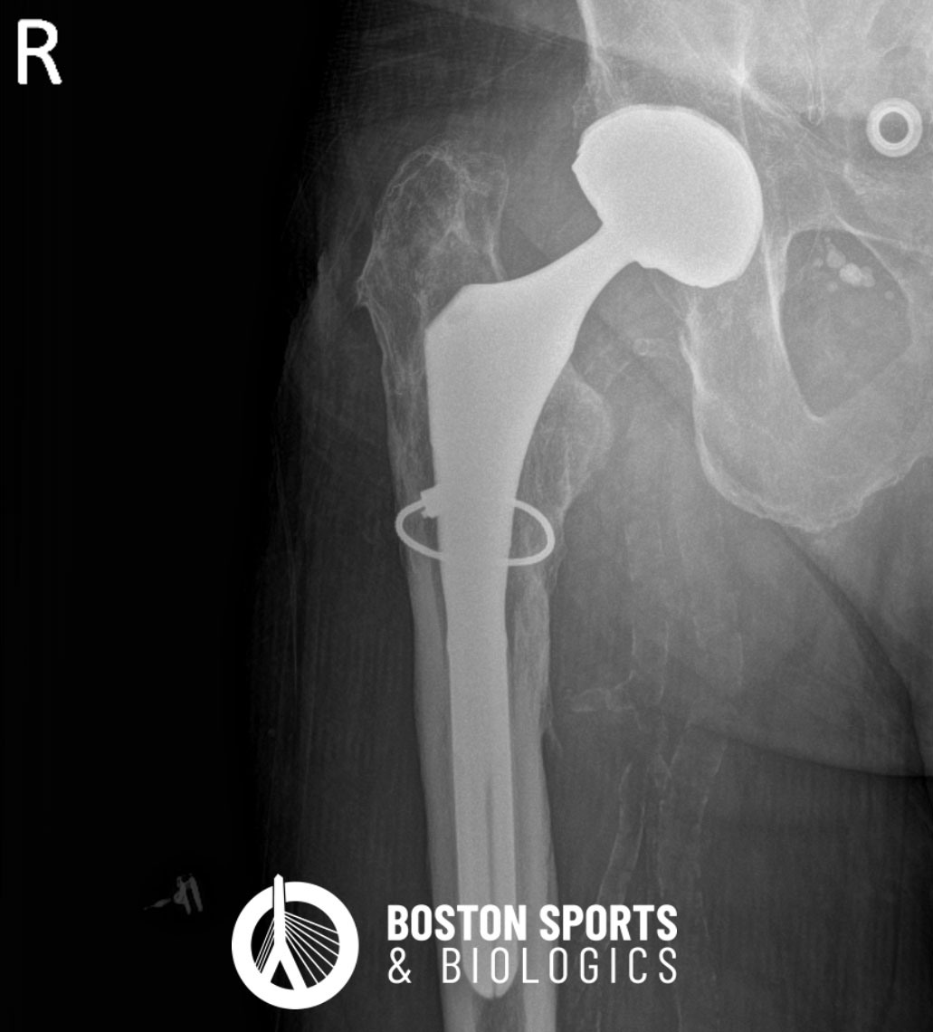 Radiograph of a hip after a hip replacement (arthroplasty).