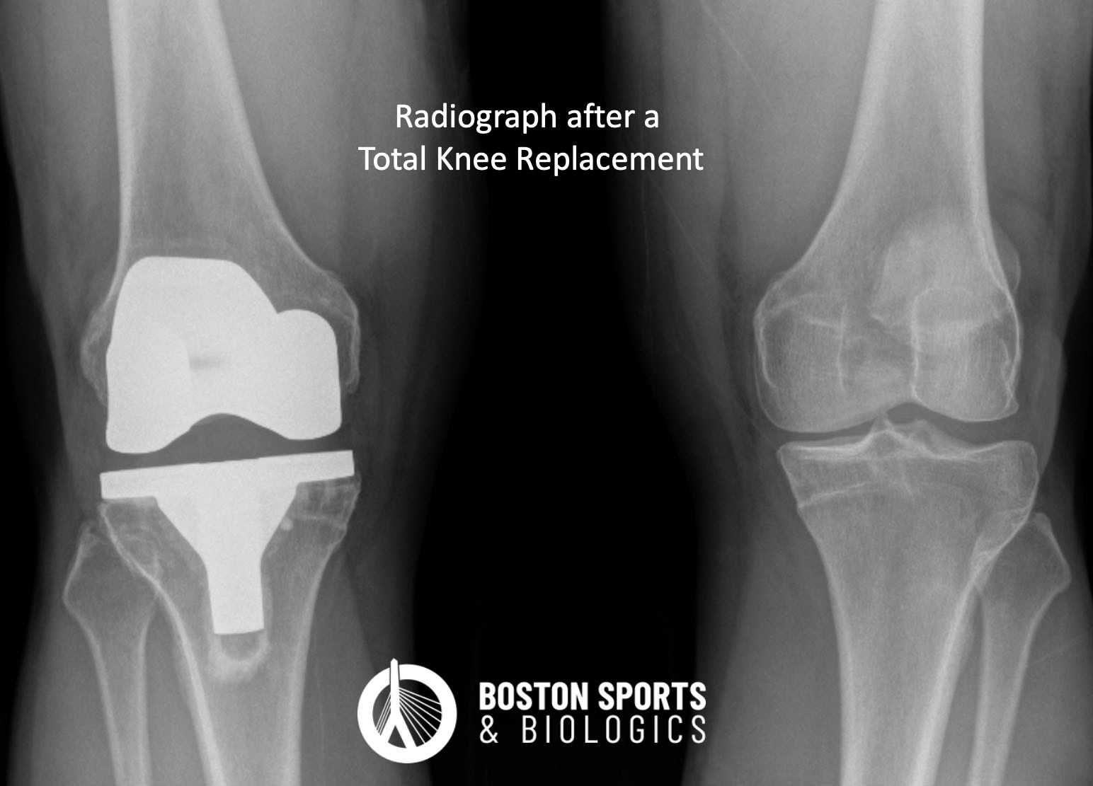 Radiograph (x-ray) after a total knee arthroplasty/replacement.